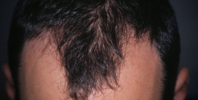 alopecia-androgenetica_800x521