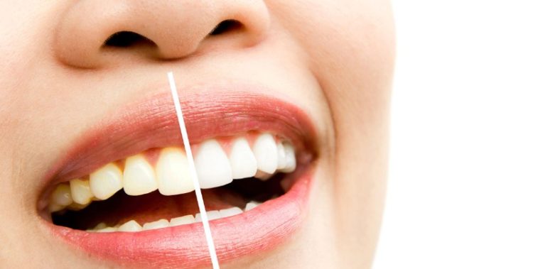 i-peggiori-nemici-dei-denti_800x533